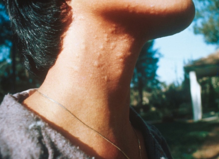 תגובה אלרגית לשערות הרעילות של התהלוכן. צילום: אתר קקל